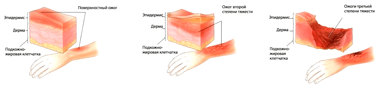 Как выглядит ожог после